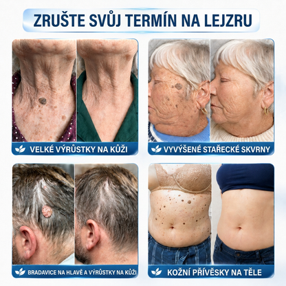 👩‍⚕️🎁Ametlik pood | MURWON®  Mikronõeltega plaastrid täiusliku naha saavutamiseks ja nahavigade eemaldamiseks (nahakasvajate, väikeste nahamoodustiste, tüügaste, sünnimärkide, vanuselaikude ja pigmentatsioonihäirete korral)💡