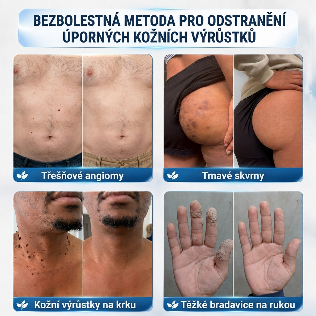 👩‍⚕️🎁Ametlik pood | MURWON®  Mikronõeltega plaastrid täiusliku naha saavutamiseks ja nahavigade eemaldamiseks (nahakasvajate, väikeste nahamoodustiste, tüügaste, sünnimärkide, vanuselaikude ja pigmentatsioonihäirete korral)💡