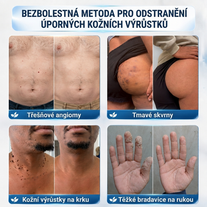 👩‍⚕️🎁Ametlik pood | MURWON®  Mikronõeltega plaastrid täiusliku naha saavutamiseks ja nahavigade eemaldamiseks (nahakasvajate, väikeste nahamoodustiste, tüügaste, sünnimärkide, vanuselaikude ja pigmentatsioonihäirete korral)💡