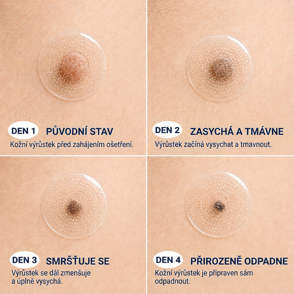 👩‍⚕️🎁Ametlik pood | MURWON®  Mikronõeltega plaastrid täiusliku naha saavutamiseks ja nahavigade eemaldamiseks (nahakasvajate, väikeste nahamoodustiste, tüügaste, sünnimärkide, vanuselaikude ja pigmentatsioonihäirete korral)💡