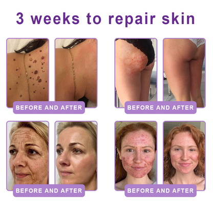 💎Vitalisys® PDRN Multi-Peptide Massaging Body Roller Cream- Anti-aging, Hydrating, Skin Firming & Lifting, Skin Repair, Even Tone, Acne and Dark Spot Treatment, Wart and Mole Removal, and Psoriasis Relief.